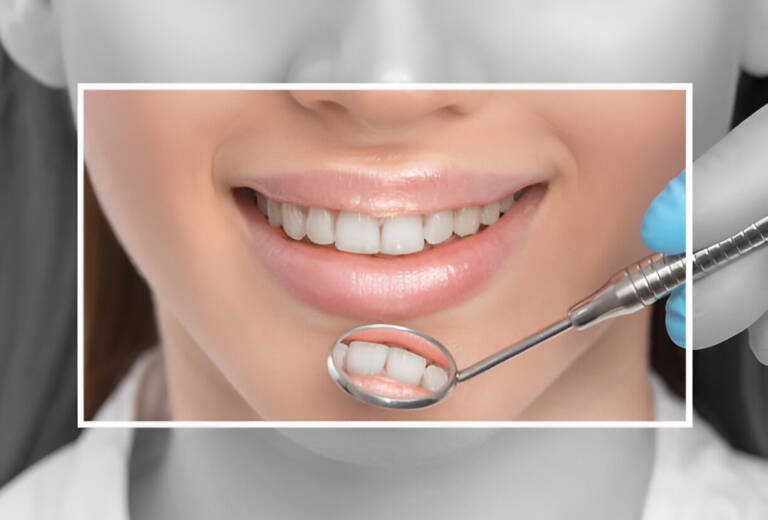 The Pros and Cons of Teeth Whitening vs. Veneers: Which is Better for You?