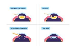 How Does Lens Replacement Surgery Work – Understanding The Procedure Step-By-Step