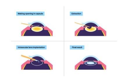 How Does Lens Replacement Surgery Work – Understanding The Procedure Step-By-Step